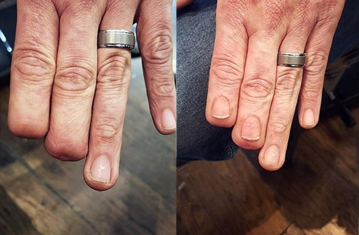 The rise of the paramedical tattoo