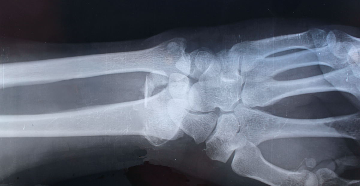 What are the early warning signs of osteoporosis?